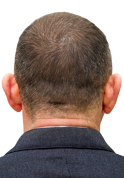 after hair transplant